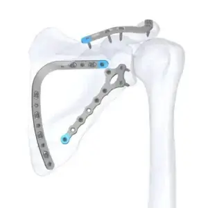 Scapula Locking Plate System